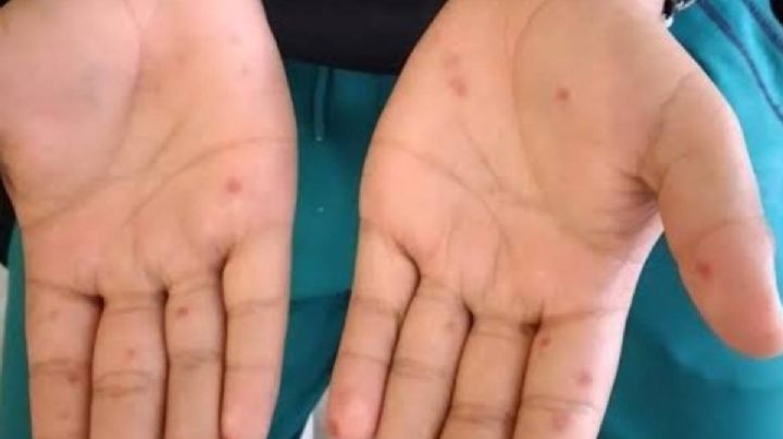 Cancelan celebración del Día de Muertos en Mesones Hidalgo, OAXACA, por brote del virus Coxsackie; hay más de 30 casos