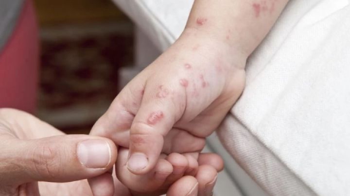 Virus Coxsackie supera los 900 contagios en escuelas y guarderías de OAXACA; ¿habrá suspensión de clases?