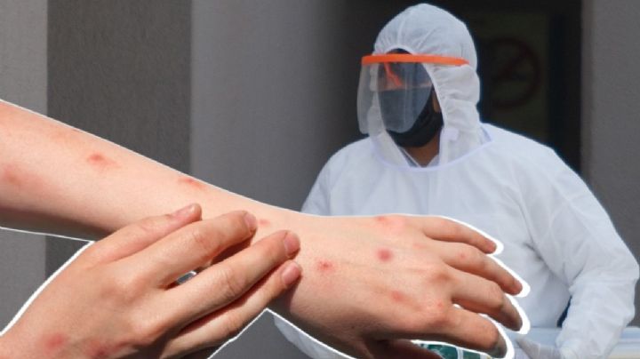 Confirman caso de Mpox en Huatulco: ¿Cómo protegerte de la viruela del mono en OAXACA?