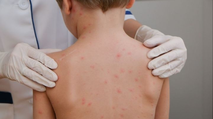 ¡Alerta! Salud confirma casos de SARAMPIÓN en OAXACA; ¿Quienes deben vacunarse?